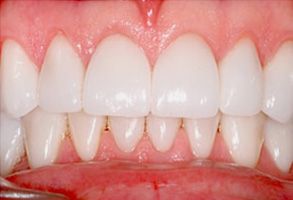 Simply Smiles Dental in Harlem | Dentures, Implant Dentistry and All-on-4 reg 